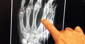 Strzała wbita w dłoń