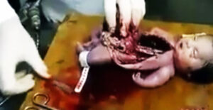 Sekcja zwłok noworodka